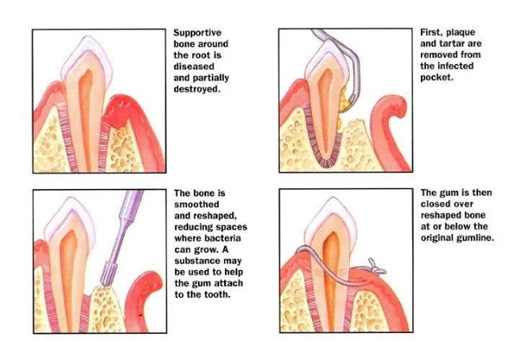 Periodontal-Flap-Surgery